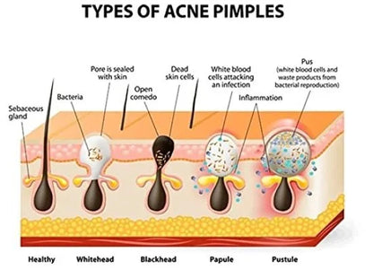 Nose Strips – Instant Blackhead Remover (10 Pcs. Family Pack)