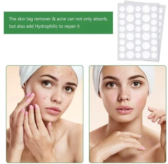 36 pcs Acne Patch – Pimple Healing Spot Treatment